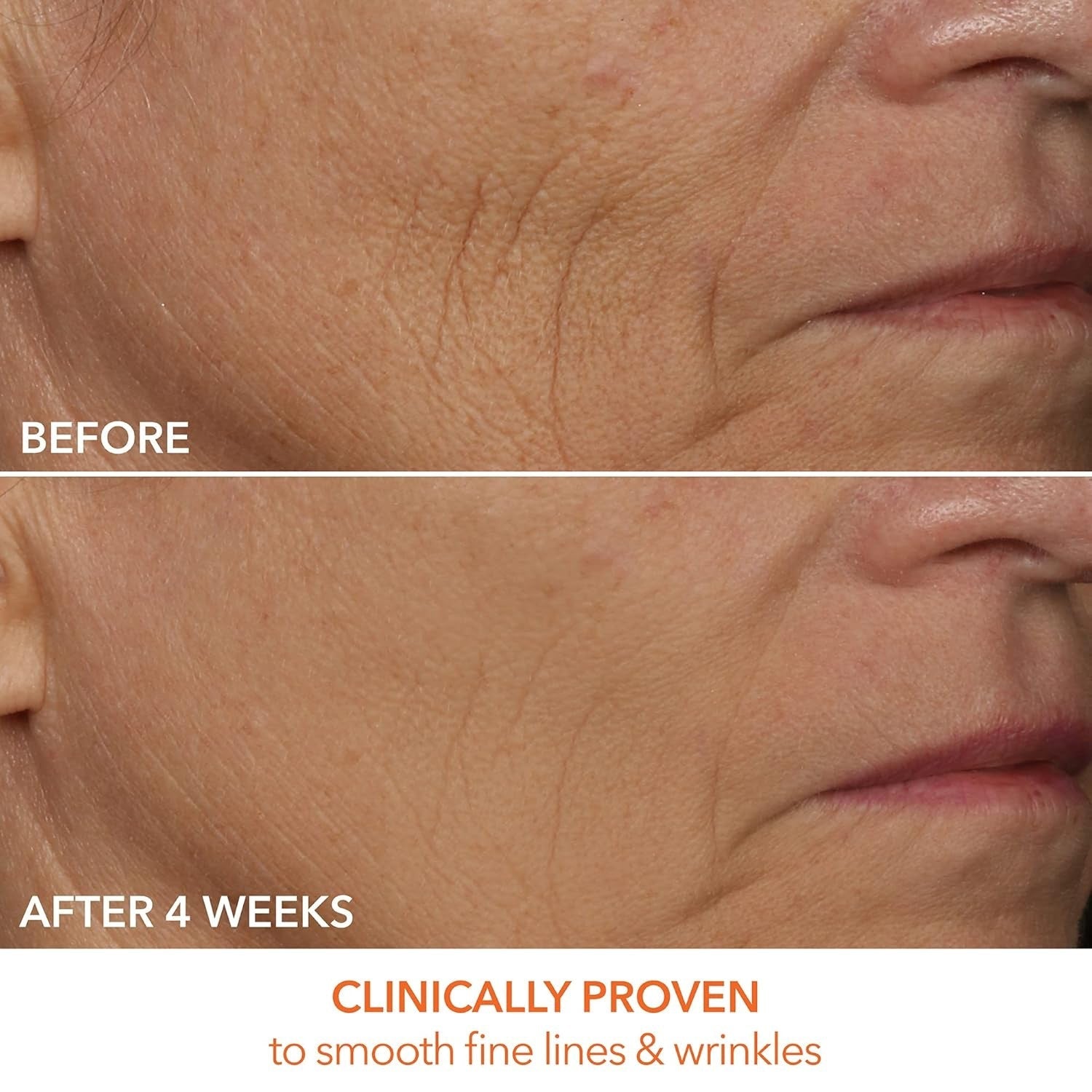 LED mask results on facial skin: before and after fine lines comparison