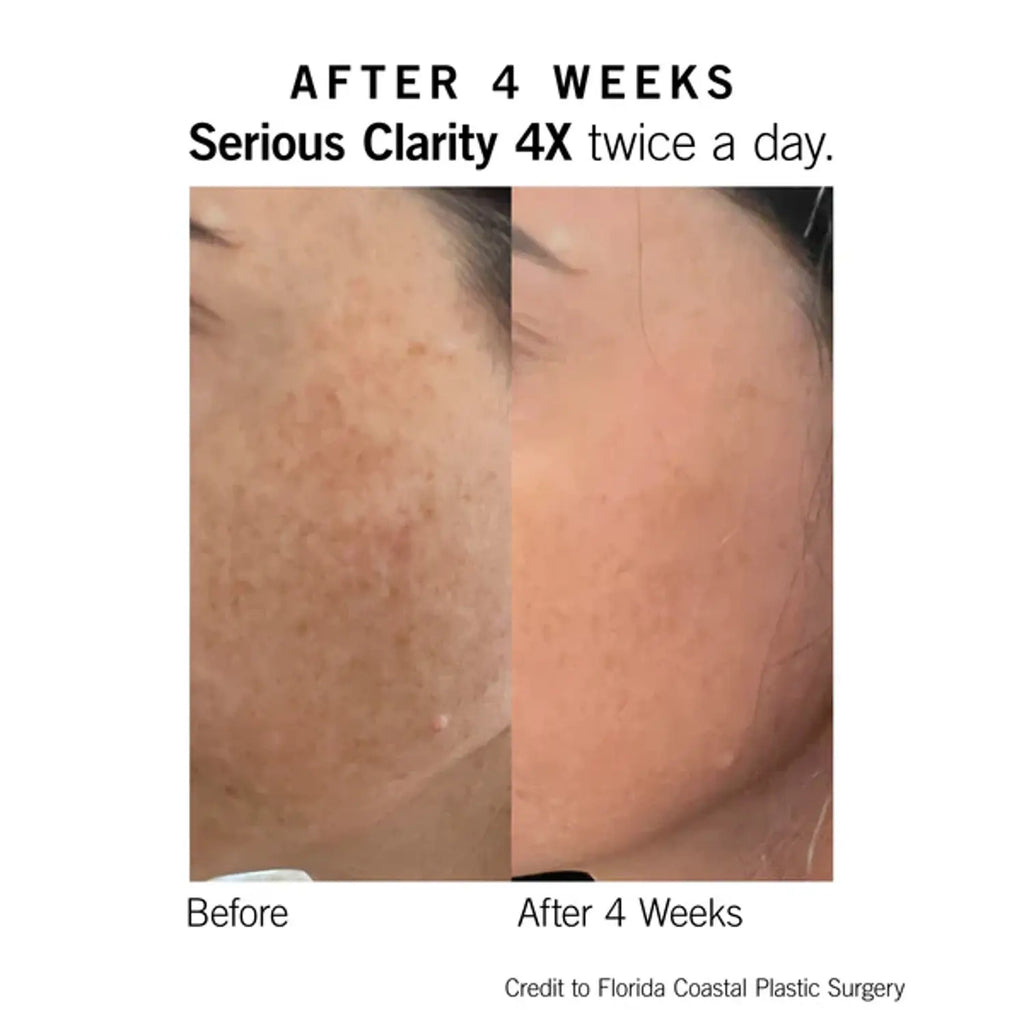 Skin before-and-after photo with text 'After 4 weeks' and 'twice a day'