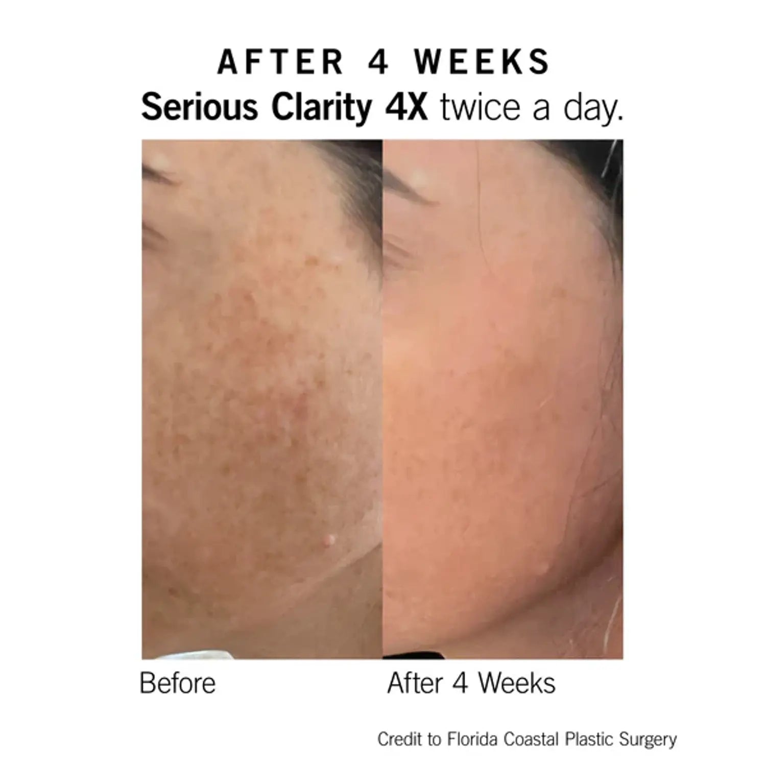 Skin before-and-after photo with text 'After 4 weeks' and 'twice a day'