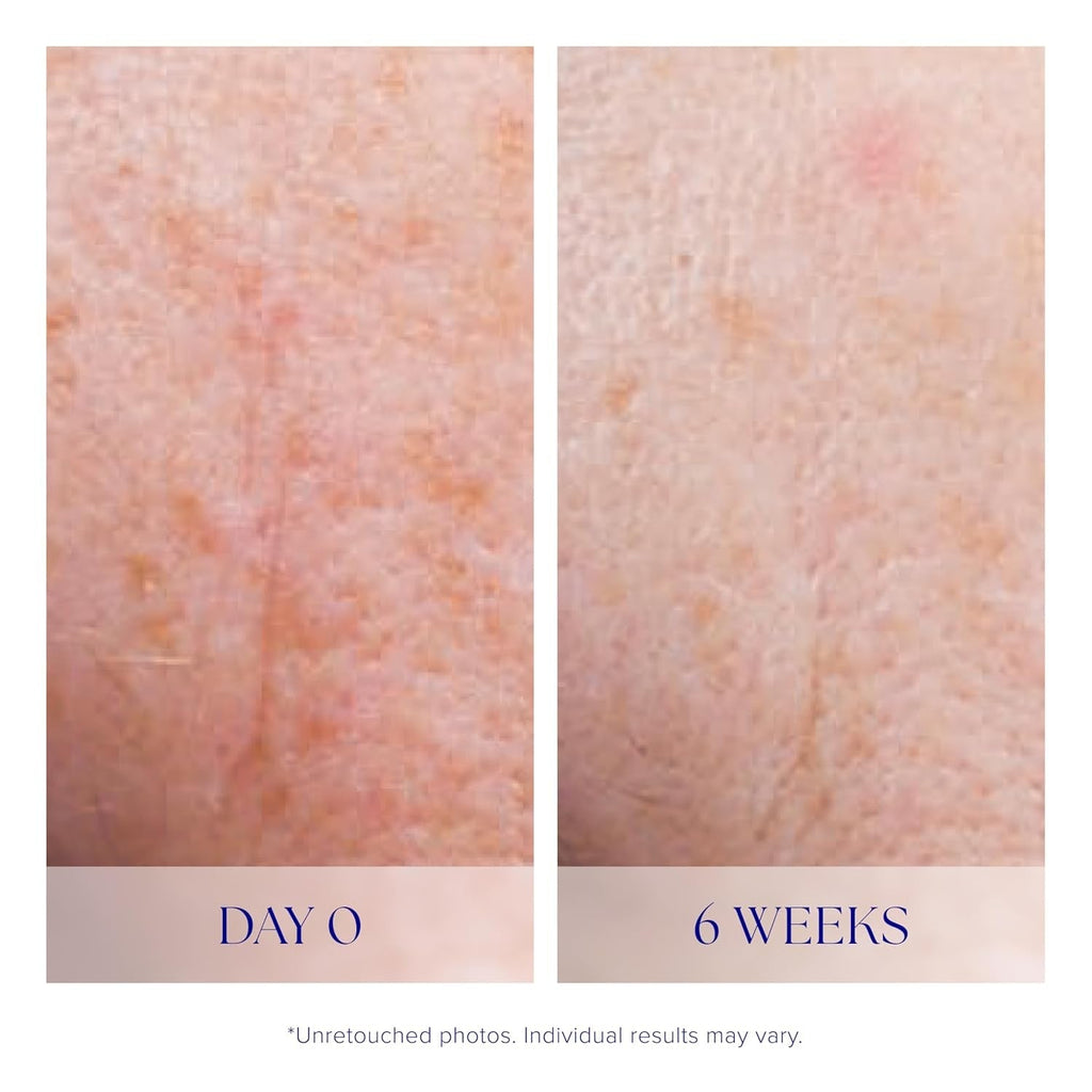 Two panels of facial skin showing smoother appearance after treatment