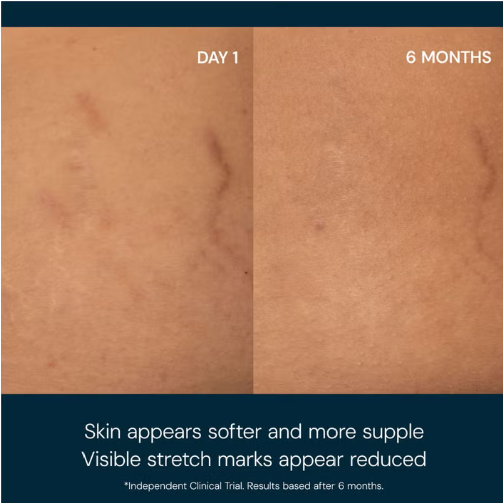 Skin comparison for body oil blend: day 1 versus 6 months