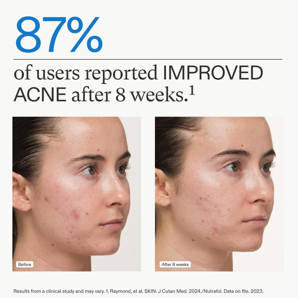Acne skin before-and-after comparison photos of two women profiles