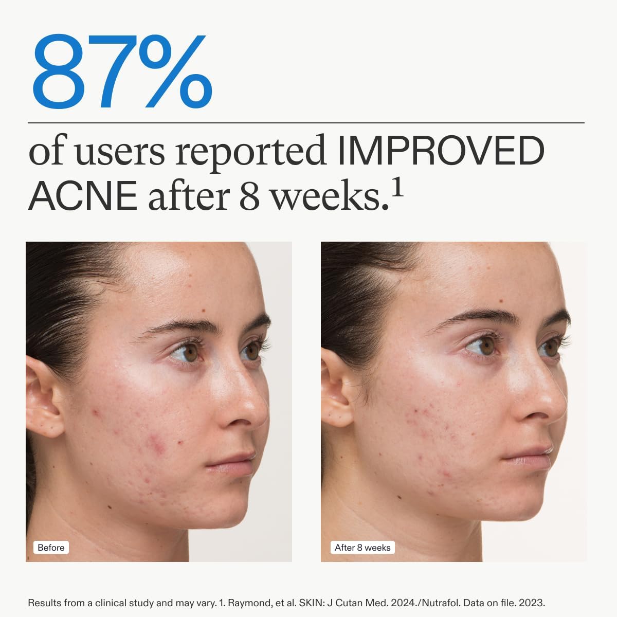 Acne skin before-and-after comparison photos of two women profiles